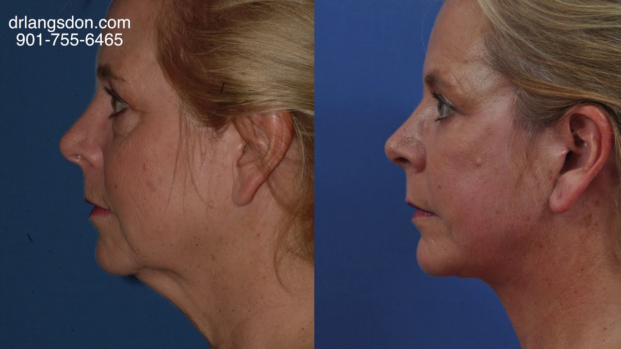 Dr. Langsdon Discusses Facelift Procedure