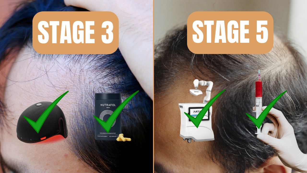 Male Pattern Baldness Stages: What Works at Each Stage (Norwood 1–7)