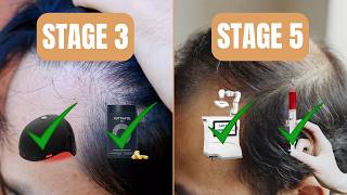 Male Pattern Baldness Stages What Works At Each Stage Norwood 17