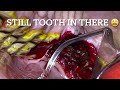 Extracting a fractured upper cheek tooth in a horse