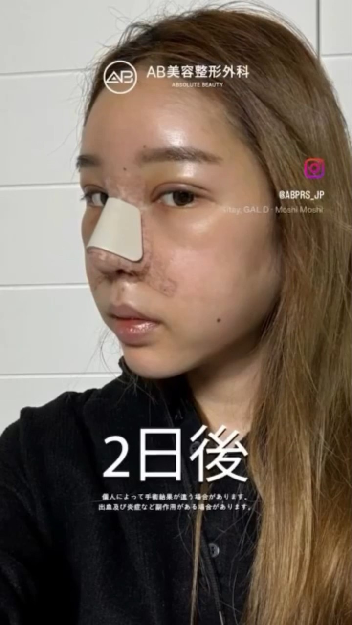 [韓国整形] 目整形 + 鼻整形 #ab美容整形外科