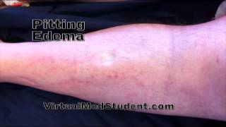 Pitting Edema (Physical Exam Finding)