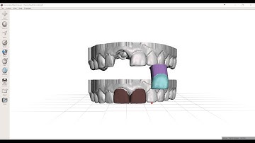 Mirroring a Central Incisor in Meshmixer