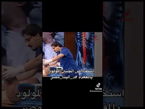 استخلاص الجنين المولود بالمقعده