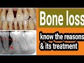 Bone loss in teeth; Dr. Praveen Bhatia