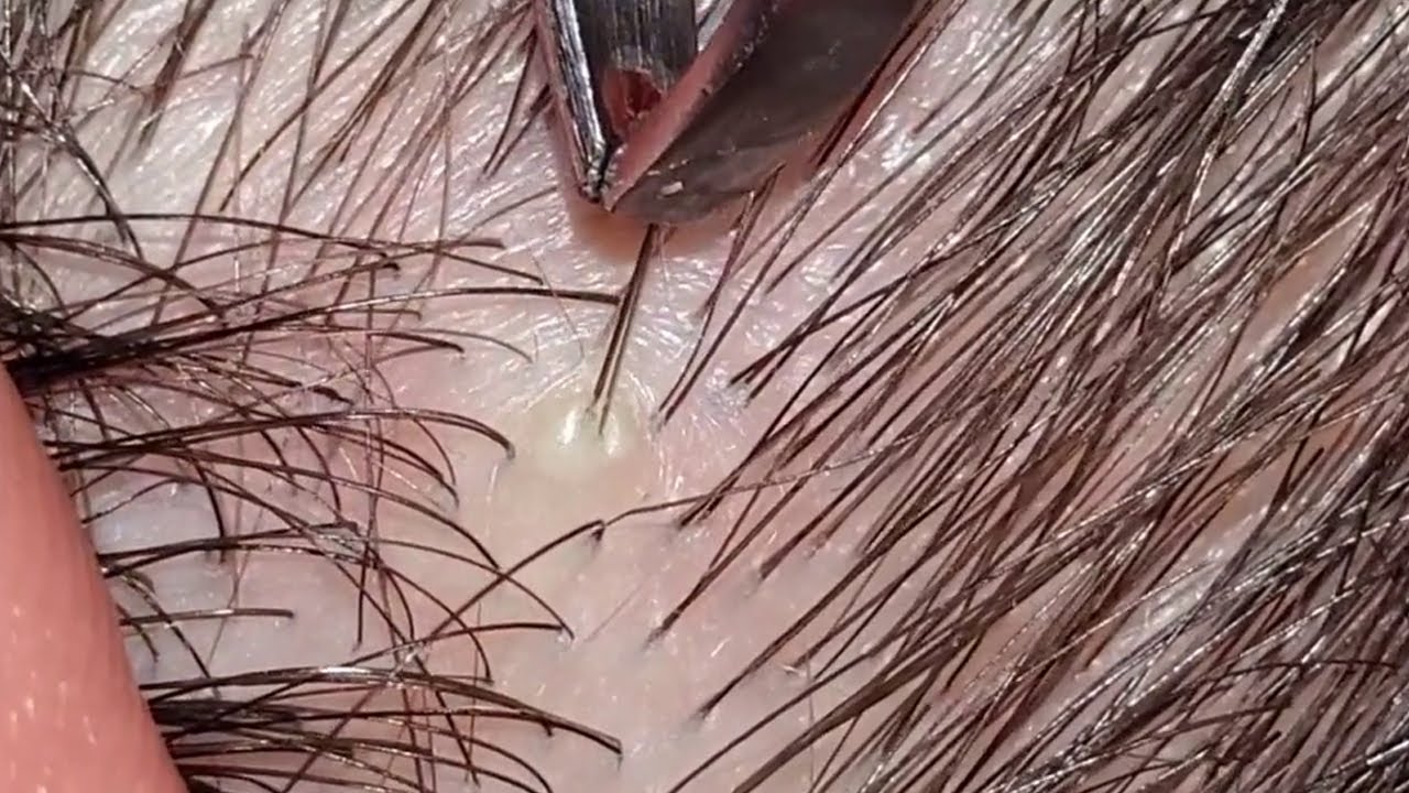 The Most Satisfying ingrown hair Pulling Juicy Hair Part 44 YouTube