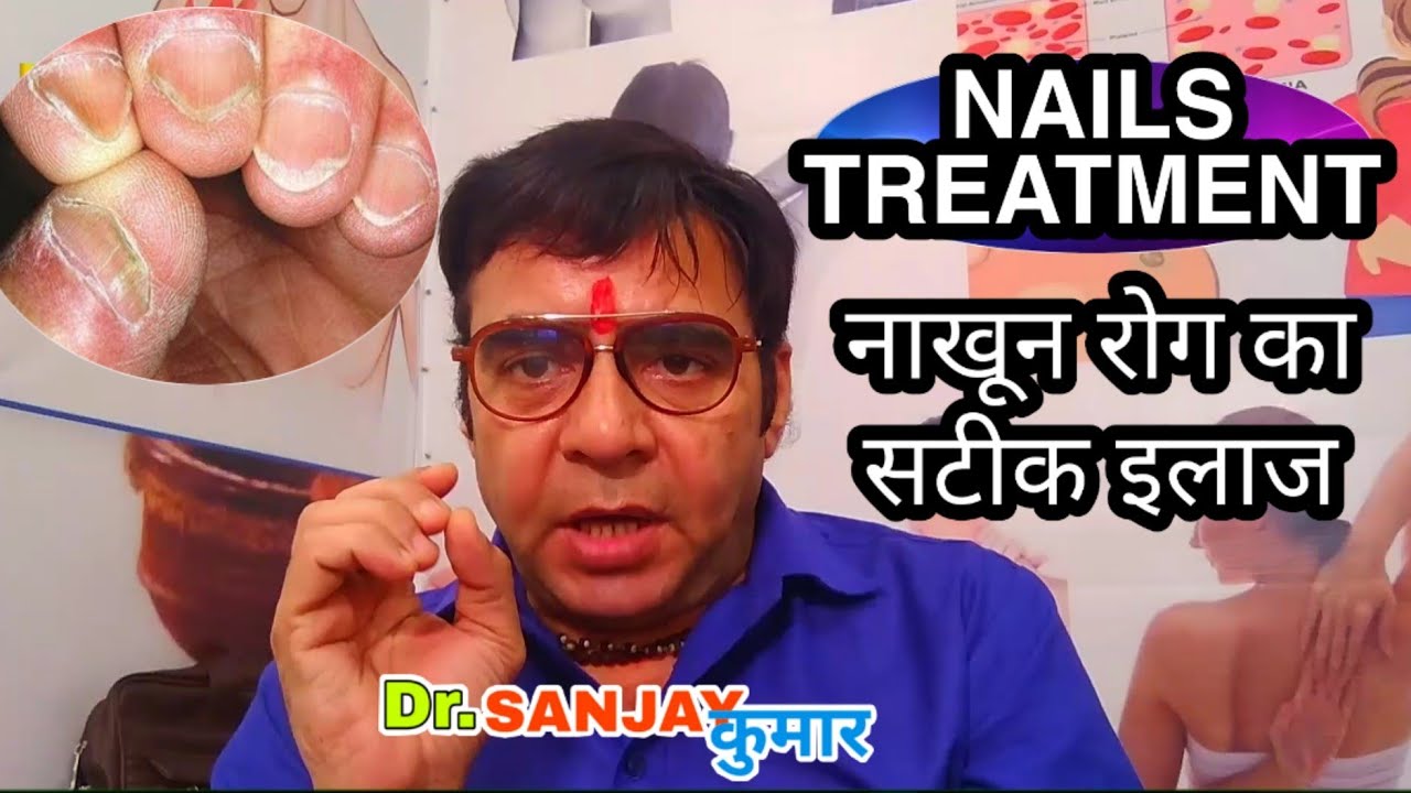 Nail Treatment at home Nakhun Ke Rog Ka Ilaj Nails Treatment in