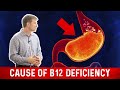 Vitamin B12 Deficiency: The most common Cause - Dr. Berg