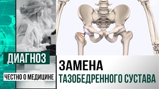 Эндопротезирование тазобедренного сустава: как проводят операцию в Казахстане | Диагноз