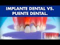 Implante dental VS Puente dental fijo sobre diente natural  - ¿Cuál es mejor? ©