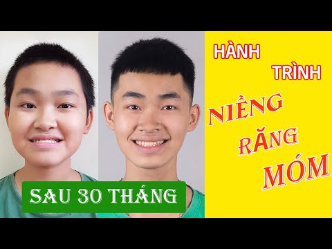 Video Cận cảnh quá trình niềng răng móm siêu nặng tránh được... - youtube
