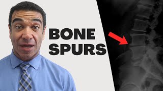 Can Bone Spurs Go Away? - Frederick Chiropractor