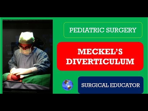 MECKEL&rsquo;S DIVERTICULUM-- How To DIAGNOSE & TREAT?/  Pediatric Surgery
