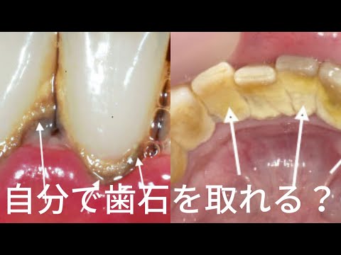 黒い歯石と白い歯石の違い　歯石を自分で取る方法はある？