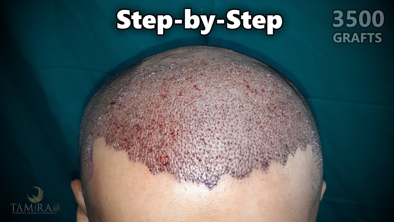 StepbyStep Process of Hair Transplant in Chennai TamiraLife YouTube