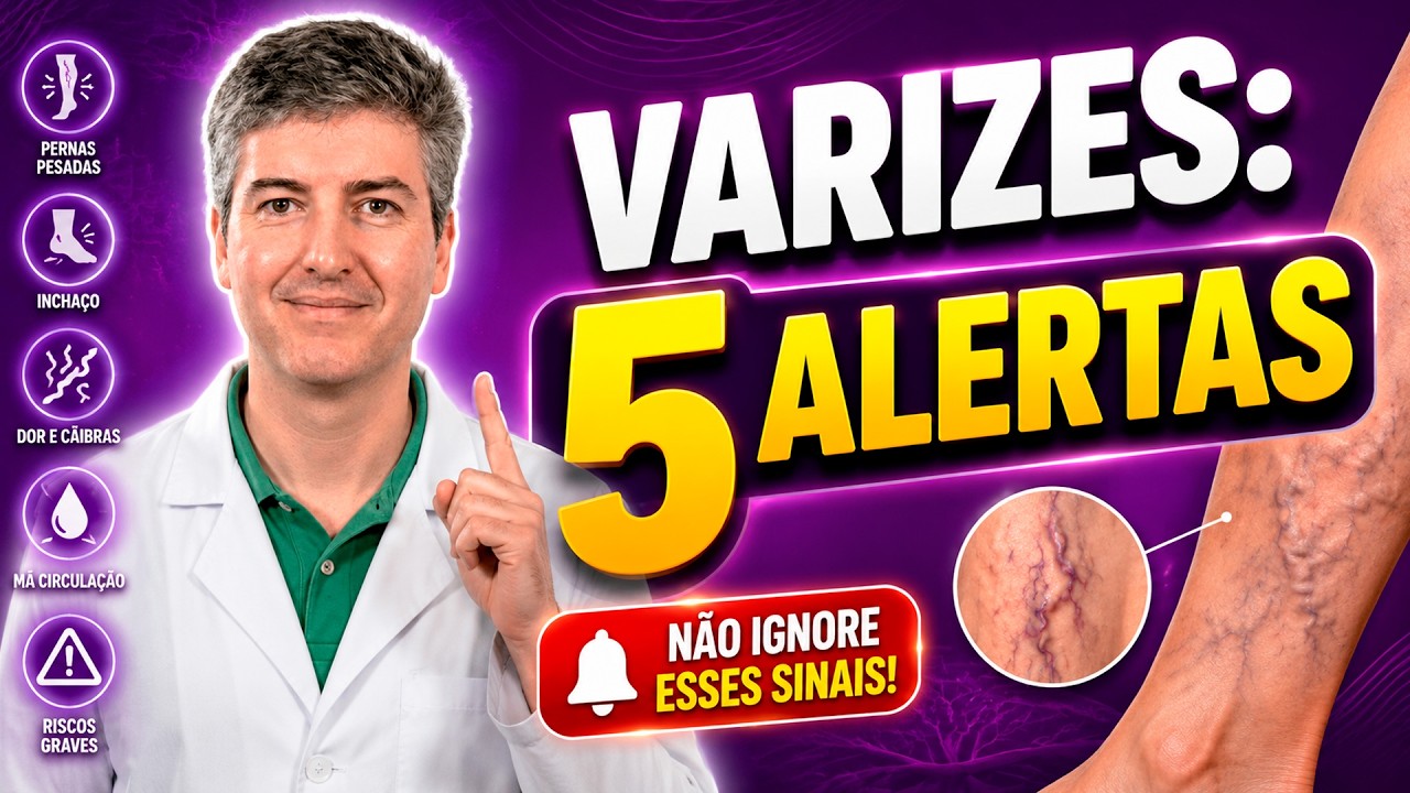 Cuidado com as varizes! 5 sinais de risco que você não pode ignorar