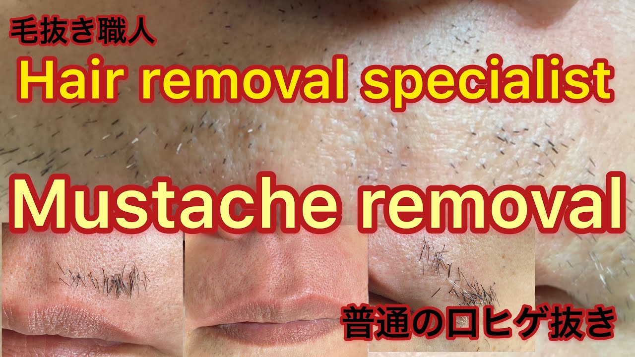 【Plucking facial hair】ずっと見ていられる警告のヒゲ抜き 2020.6.10（鼻下ヒゲ全部抜き）【Mustache removal】 YouTube