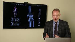 Posterior Cruciate Ligament (PCL) Injuries