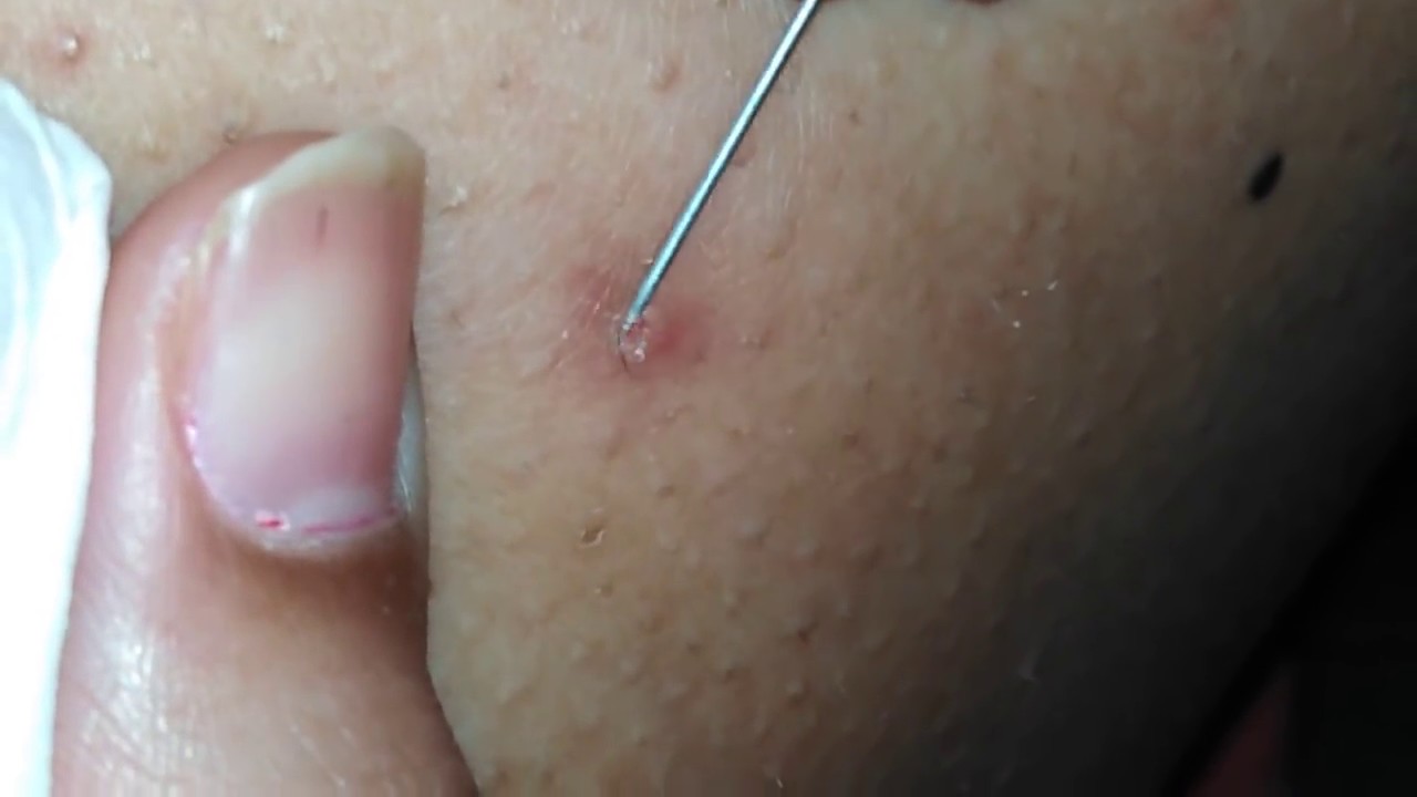 Ingrown Hair On Thigh Pictures