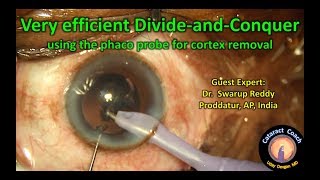 Cataract Coach guest surgeon very efficient divide and conquer