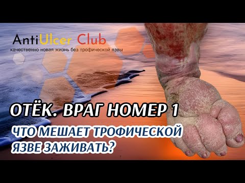 Почему язвы на ноге не заживают. Враг номер 1, мешающий заживлению.