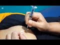 Girl IM injection hospital #iminjection #injection #dexamethasone