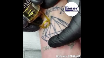 Live Laser Tattoo Removal 1st Session on inner wrist at The Laser Studios in Hitchin near London, UK