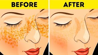 How to Get Rid of Acne Scars In Just 3 Days