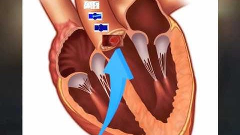 ME 120: Aortic Valve Comsol Simulation [Fall 2016]