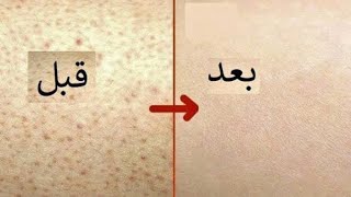 روتين علاج جلد الوزه من اول استخدام مرهم ديبروساليك وكارباميد