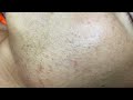 Pimples Blackheads On Face P3 | Mụn Đầu Đen Trên Mặt P3 - SacDepSpa#287