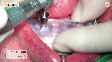 Hiossen - OneGuide Live Surgery