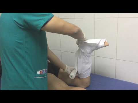 Video: Cómo tratar las piernas agrietadas (fracturas por estrés): 12 pasos