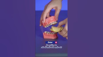 Niềng răng ăn được bim bim gì?? | Lạc Việt Intech Niềng Răng #shorts