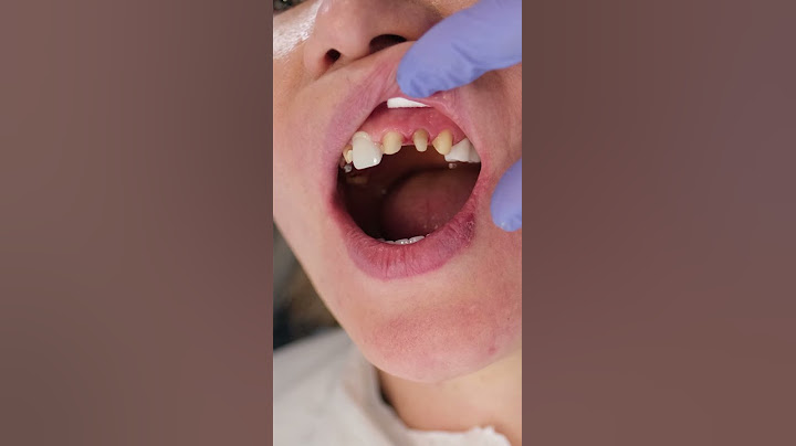 GÖRDÜĞÜNÜZ GÜZEL GÜLÜMSEMELER BÖYLE YAPILIYOR #veneer #zirconium #dentist #smiledesign