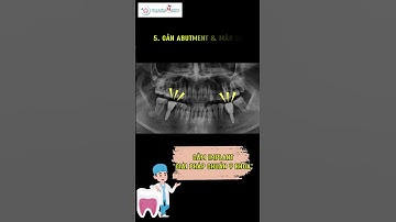 Cấy Ghép Implant – Tạm Biệt Răng Mất, Tự Tin Cười Tỏa Sáng | Nha Khoa MARINA #nhakhoamarina #dentist
