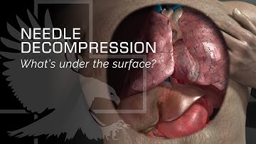 Needle Decompression:  What’s under the surface? #bethedifference #beprepared