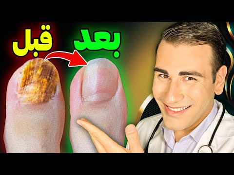 تصویری: ناخن های پا چه کسانی زرد می شوند؟