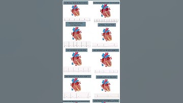 Most common Arrhythmias (heart motion + rhythm strip) #cardiology #medicalstudent #usmle #medstudent
