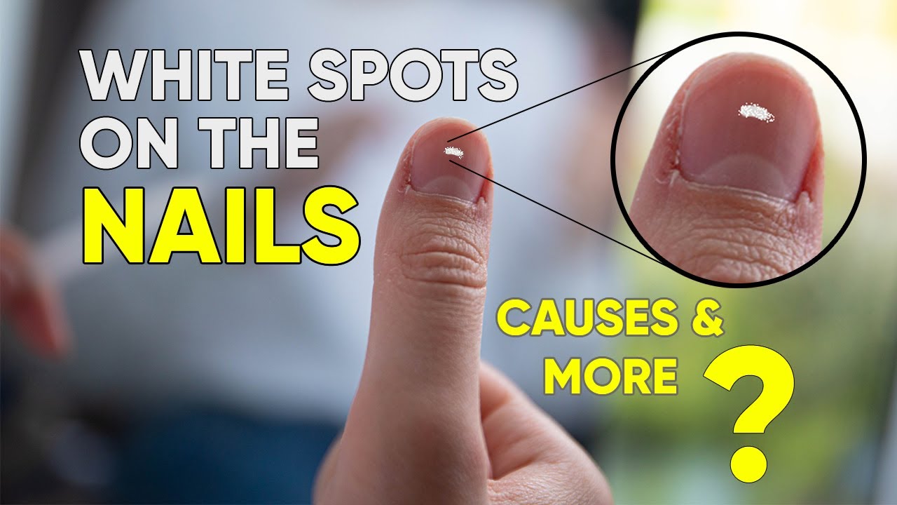 White Spots On Nails Stock Photo - Download Image Now - Fingernail,  Spotted, White Color - iStock