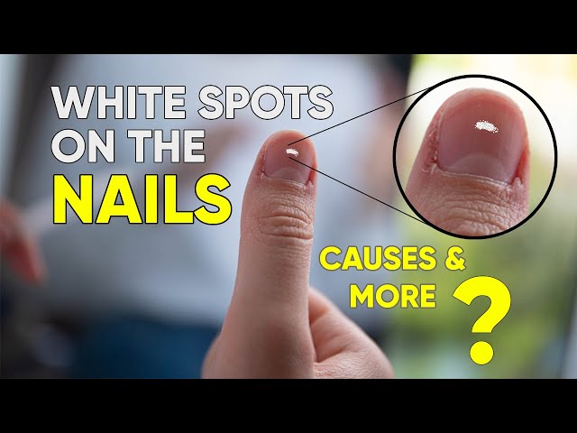 Onycholysis (Nail Separation): Symptoms, Causes & Treatment