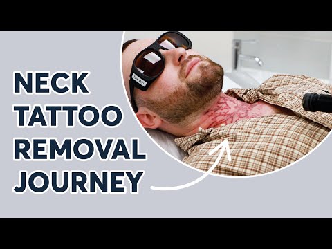 Laser Tattoo Removal Journey | London