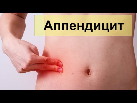 Аппендицит. Клиника, диагностика, лечение.