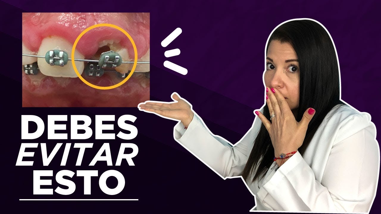 10 cosas que debes saber ANTES de usar ORTODONCIA  Joana Campolargo