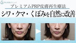 プレミアムprp皮膚再生療法とは 若返り アンチエイジング 美容整形 美容皮膚科なら聖心美容クリニック