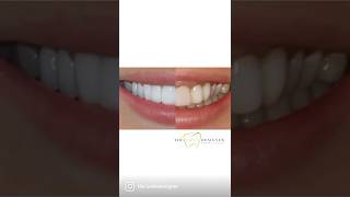 Gummy Smile Treatment with crown lengthening and veneers | The Smile Designer