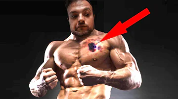 Quando si muore per melanoma?