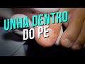 UNHA DENTRO DO PÉ (NAIL INSIDE THE FOOT) - PODÓLOGO MAURÉLIO