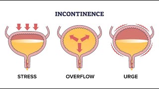 Overflow Incontinence (Urine Incontinence) ; Definition, Causes, Symptoms, Diagnosis, Treatment