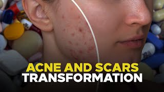 Skin Transformation Unleashed Secrets Of Spironolactone And Doxycycline For Acne & Scars